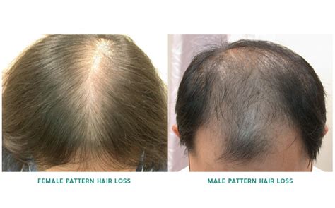 Hair Loss Treatment In Singapore Various Treatment Options