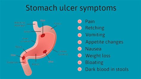 what Peritonitis means? - Causes, Symptoms, Test, and Treatment