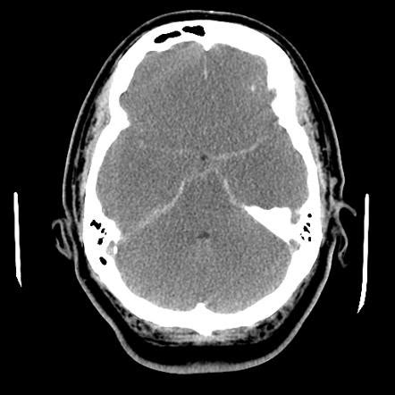 Subarachnoid Hemorrhage Radiology Reference Article Radiopaedia Org