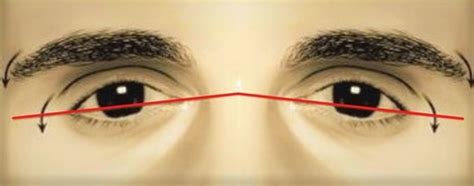 negative canthal tilt