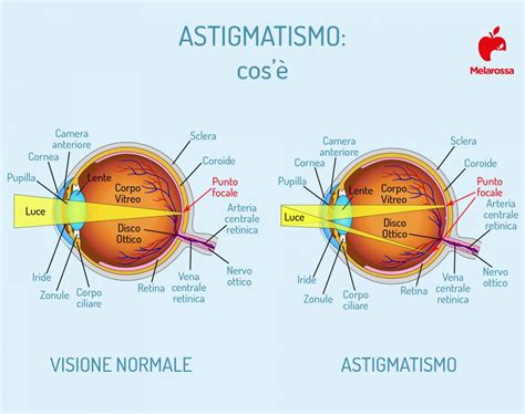 Astigmatismo cos è cause sintomi diagnosi e cure