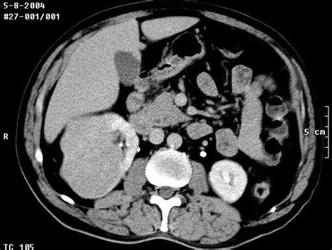 Carcinoma de células renales y síndromes hereditarios asociados