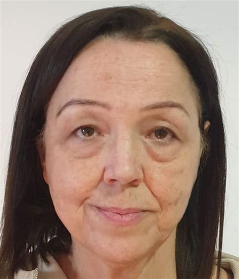 Resultados Blefaroplastia antes y después Resultados