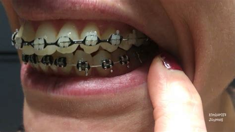 Braces Girlswithbraces Powerchain Beautiful Smile Braces Beautiful