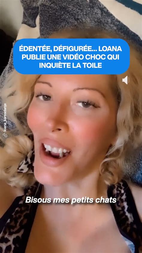 Loana Sans Dents Et Défigurée Dans Une Vidéo Postée Sur Son Instagram 😳