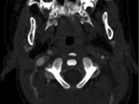 Screening Ct Angiography For Pediatric Blunt Cerebrovascular Injury