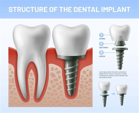 TOT ce trebuie să știi despre implanturile dentare De câte tipuri sunt