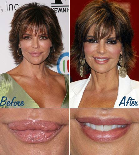 Chatter Busy: Lisa Rinna Lip Surgery