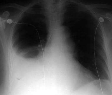 Left Hemothorax X Ray