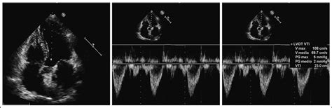 Left Ventricular Outflow Tract Velocity Time Integral Improves Outcome Prediction In Patients