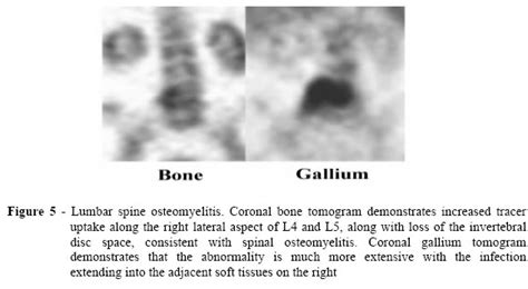 Osteomyelitis Bone Scan