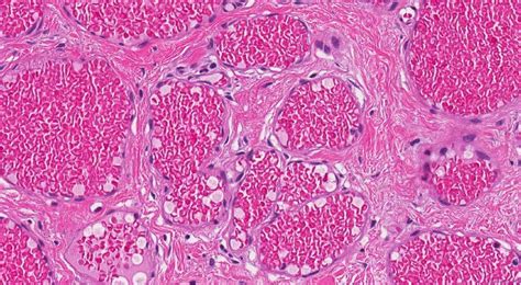 Capillary Hemangioma Of The Skin Ottawa Atlas Of Pathology