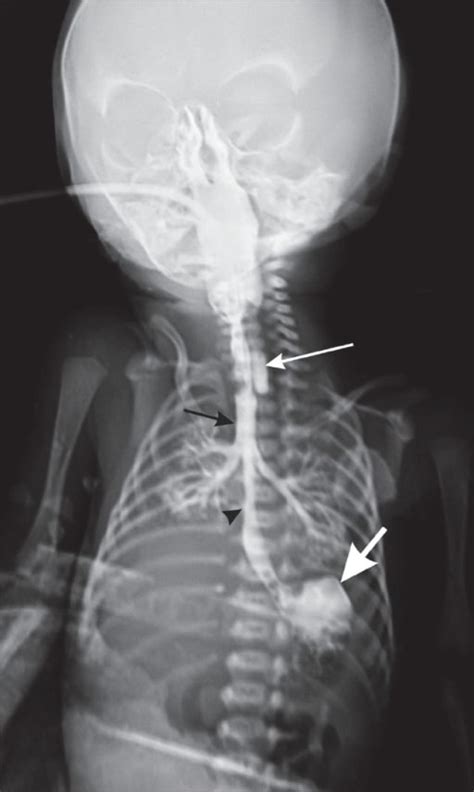 Esophageal Atresia And Tracheoesophageal Fistula Concise Medical