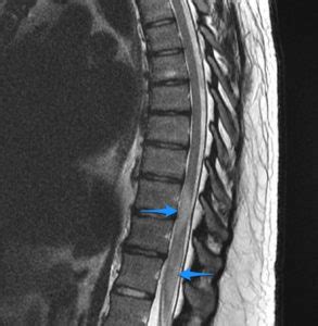 Neuromyelitis Optica Causes Symptoms Diagnosis Treatment