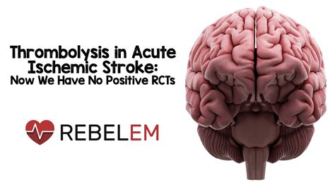 Thrombolysis In Acute Ischemic Stroke Now We Have No Positive Rcts Laptrinhx News