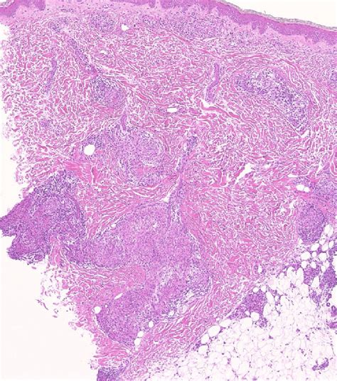 Histological Features Of The Erythema Nodosum Like Sarcoid Lesion Download Scientific Diagram