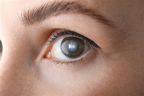 All You Need To Know About The Different Types Of Cataracts