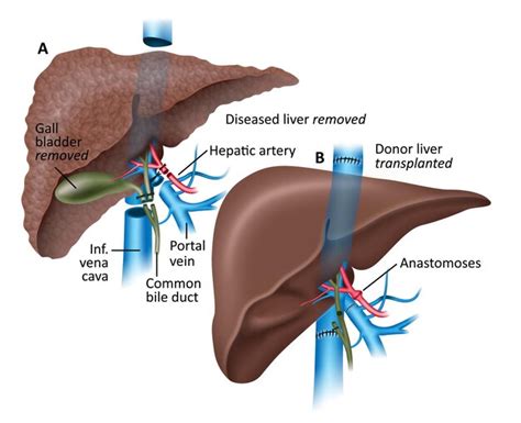 Premium Vector Liver Transplant