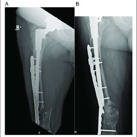 A And B A Post Op Ap Femur Vancouver C Fracture B Ap Femur