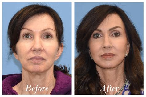 Before After C02 Laser Procedures In Fruitland Park FL VIP