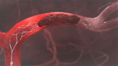 Mechanical Thrombectomy Devices Market Report 2026 | MTI