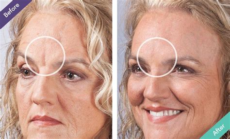 Wrinkle Filler Review Artofit