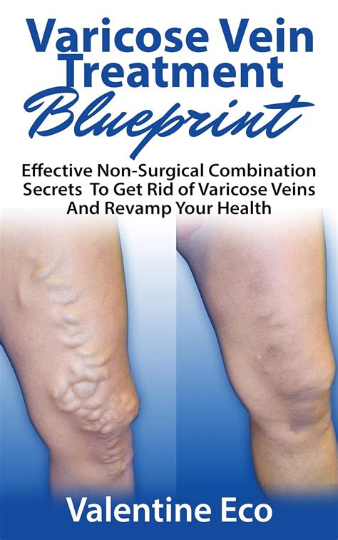 Varicose Vein Treatment Blueprint Effective Non Surgical Combination