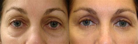 Lower Blepharoplasty Dr Guy Massry