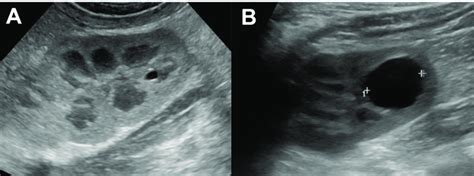 Kidney ultrasound shows renal cyst. (A) tiny right renal cyst was noted ...