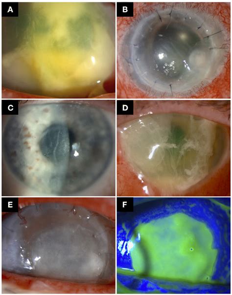 Examples Of Post Keratoplasty Infectious Keratitis PKIK A A Case