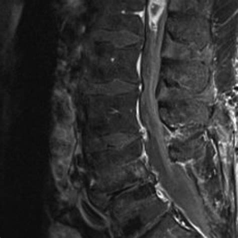 Sagittal Contrast Enhanced T1 Weighted Magnetic Resonance Image