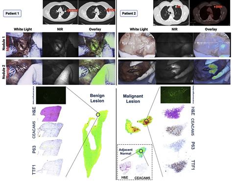 Oa1405 Intraoperative Molecular Imaging Guided Resection Of Ceacam5 Lung Tumors First In