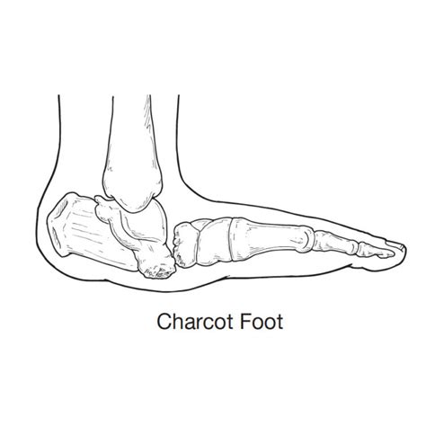 Charcot Foot - Sun Valley Foot & Ankle