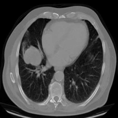 Lung Cancer Test Instance Segmentation Dataset By Lungcancerdataset