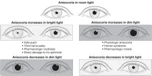 Anisocoria - American Academy of Ophthalmology