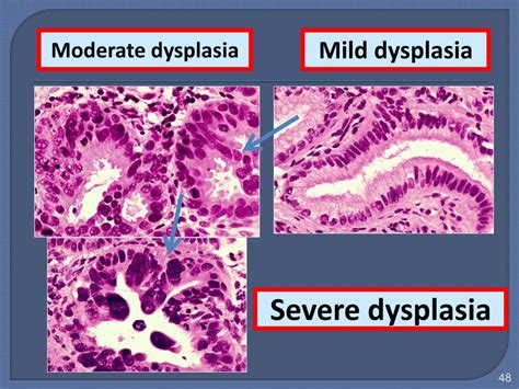 Ppt Neoplasia Powerpoint Presentation Free Download Id 6161338