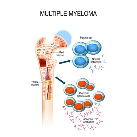 Multiple Myeloma Symptoms Causes Risk Factors And Treatment