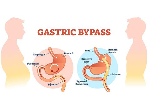 Gastric Bypass Surgery In Bodrum A Comprehensive Guide