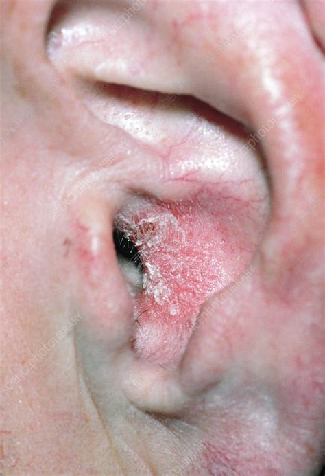 Seborrheic Eczema In Ear