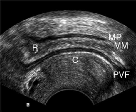 Sagittal Transvaginal Sonography Passing Through The Cervix And The