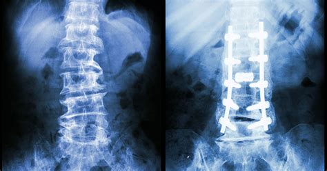 Lumbar Pedicle Screw Fixation Cd Horizon Sextant System