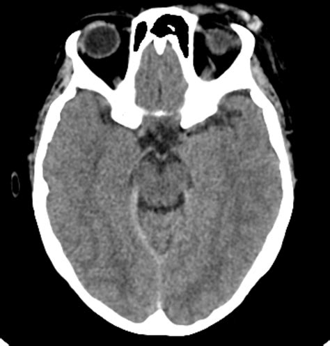 Tentorial Subdural Hematoma Radiology Case Radshare Net