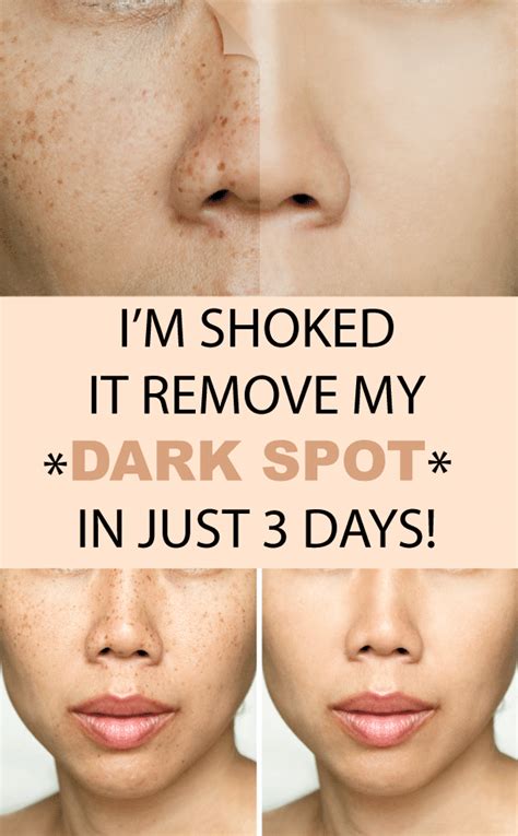 This 2 Ingredient Remedy Removes All Spots From Your Face In Just 3 Nights Remove Dark Spots