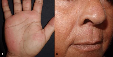 Cutaneous Lesions A Round Keratotic Palmar Pits B Millimetric