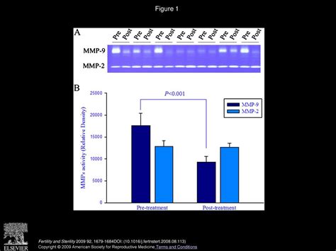 Significant Elevation Of Plasma Matrix Metalloproteinase 9 Level And Its Ratio To Matrix