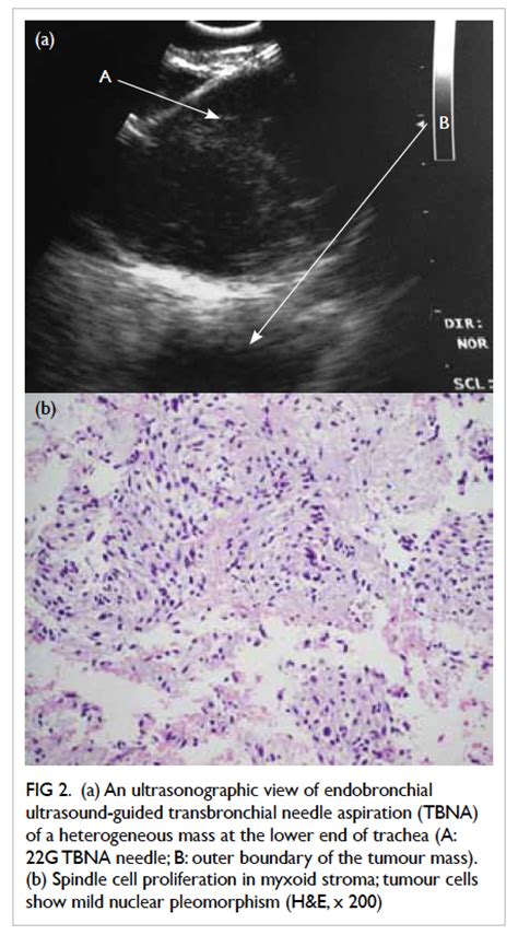 Pulmonary Artery Sarcoma Diagnosed By Endobronchial Ultrasound Guided