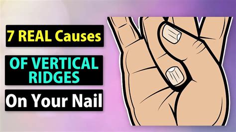 7 Real Causes Of Vertical Ridges On Your Nails Youtube