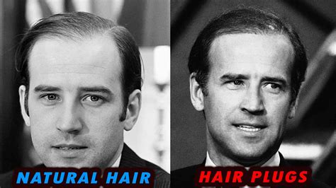 Joe Biden Old School Hair Plugs and Hair Loss Story