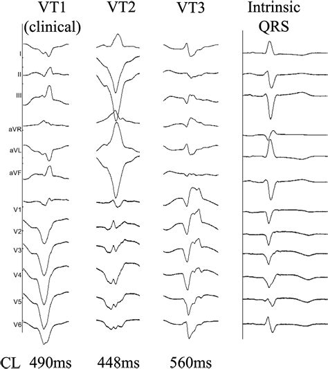 Unlocking Complex Pathways In Ventricular Tachycardia Ventricular