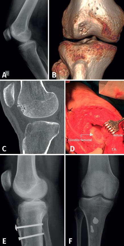 Manejo De Las Fracturas Osteocondrales De La Rodilla Fondoscience